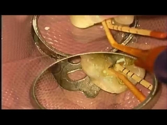 SANI درمان مورد